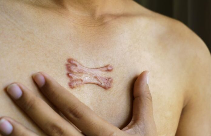 Boylecheloid: Everything You Need To Know